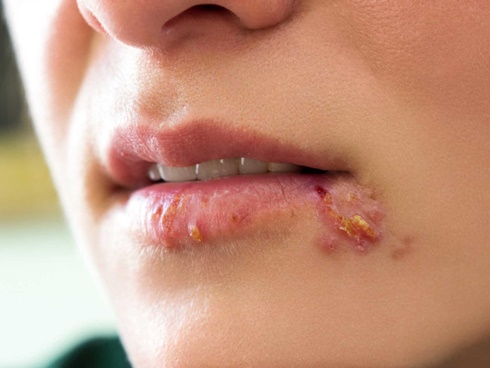 Nụ hôn thần chết không chỉ đe dọa trẻ em, qua nụ hôn người lớn cũng có thể bị bệnh tình dục nguy hiểm-4