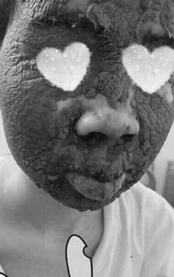 Nhầm tưởng lên đời nhan sắc nhờ rượu thuốc, cô gái khóc ròng vì làn da nham nhở, sần sùi-3