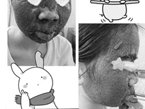 Nhầm tưởng lên đời nhan sắc nhờ rượu thuốc, cô gái khóc ròng vì làn da nham nhở, sần sùi Nhầm tưởng lên đời nhan sắc nhờ rượu thuốc, cô gái khóc ròng vì làn da nham nhở, sần sùi