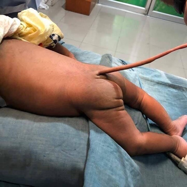 Em bé sinh ra với chiếc đuôi dài - dị tật dễ mắc và ở giai đoạn đầu mang thai, nhất là tuần thai thứ 5 và 6-2