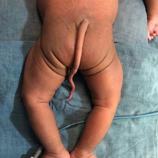 Em bé sinh ra với chiếc đuôi dài - dị tật dễ mắc và ở giai đoạn đầu mang thai, nhất là tuần thai thứ 5 và 6-1