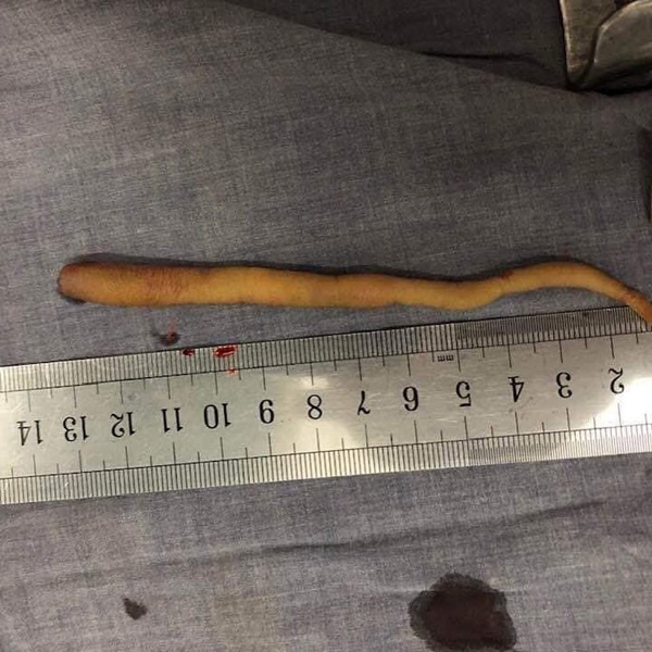 Em bé sinh ra với chiếc đuôi dài - dị tật dễ mắc và ở giai đoạn đầu mang thai, nhất là tuần thai thứ 5 và 6-4