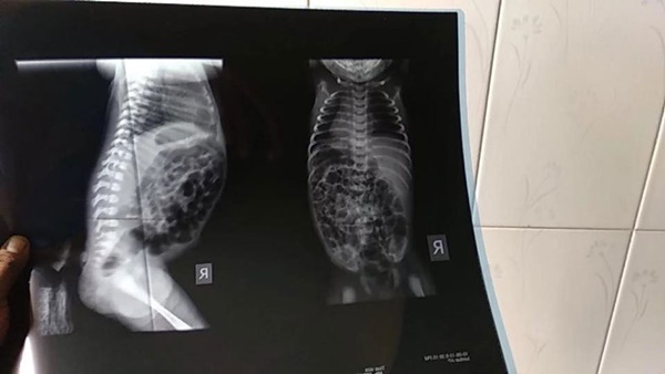 Em bé sinh ra với chiếc đuôi dài - dị tật dễ mắc và ở giai đoạn đầu mang thai, nhất là tuần thai thứ 5 và 6-5