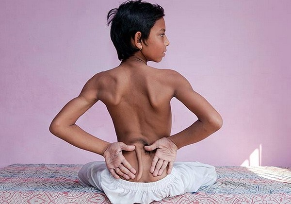 Em bé sinh ra với chiếc đuôi dài - dị tật dễ mắc và ở giai đoạn đầu mang thai, nhất là tuần thai thứ 5 và 6-6