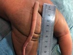 Hội chứng khiến bé trai 6 tháng tuổi mọc đuôi 5cm, em bé 11 tháng tuổi có đuôi dài 15cm và ngày càng dài-4