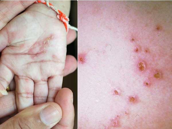 Trẻ đi bơi mùa hè, bác sĩ nhắc cẩn thận để không mắc 3 căn bệnh ngoài da thường gặp-2