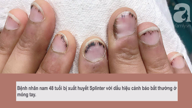 Dấu hiệu bất thường ở móng tay cảnh báo bệnh viêm van tim ít ai biết-1