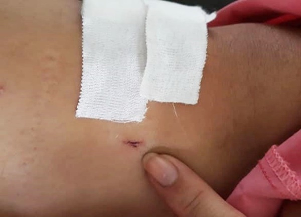 TP.HCM: Bệnh nhân bị gãy đốt sống lưng nhưng bác sĩ lại... khoan cẳng chân-3