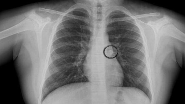 Sáng ngủ dậy thấy con mất 1 chiếc răng trong miệng, bố mẹ nhanh chóng đưa đến viện nên đã cứu được con-2