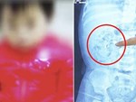 Quảng Ninh: Một bé trai 3 tuổi phải cắt thận trái, bác sĩ khuyên các cha mẹ đừng bỏ qua những biểu hiện này của con-4