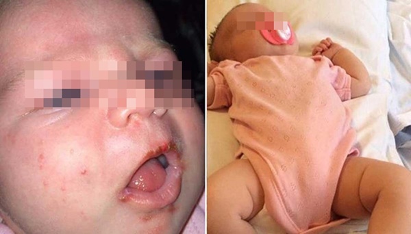 Nụ hôn thần chết không chỉ đe dọa trẻ em, qua nụ hôn người lớn cũng có thể bị bệnh tình dục nguy hiểm-1