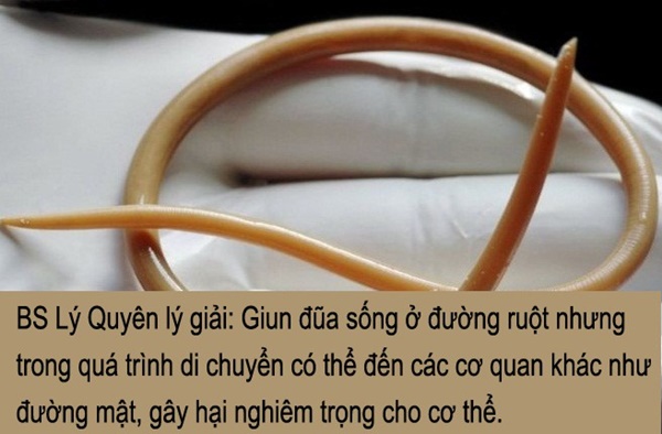 Người phụ nữ bị đau bụng hơn 10 năm, đi khám bác sĩ sốc khi phát hiện vật lạ ở trong bụng-3