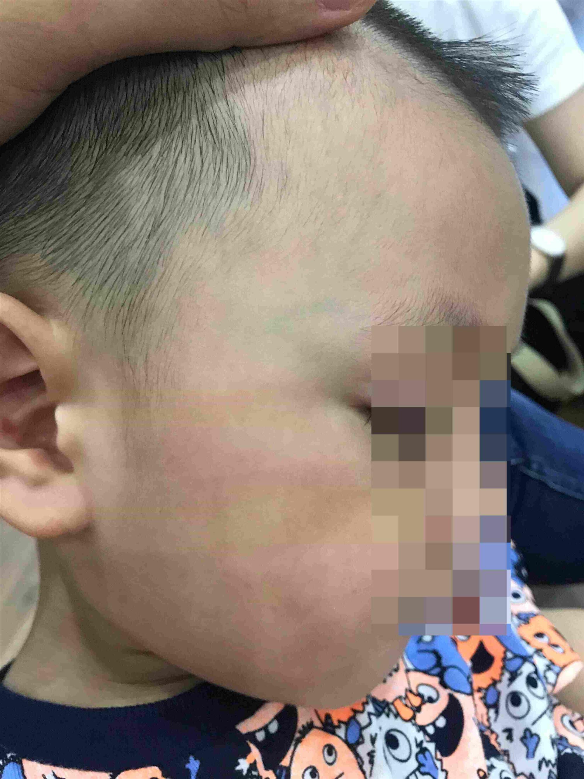 Cô giáo tát bé 3 tuổi bầm mặt, tụ máu môi-1