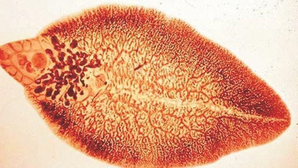 Người đàn ông bị nhiễm sán lá gan vì thích ăn loại thực phẩm không ít người cũng mê-2