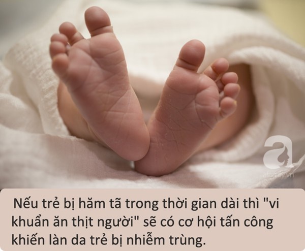 Bé 11 tháng tuổi nhiễm vi khuẩn ăn thịt người vì bảo mẫu không kịp... thay tã-1