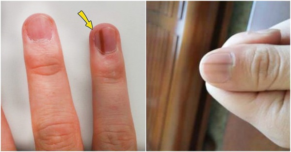 Thấy bàn tay có 1 trong 4 dấu hiệu này: Đi khám ngay vì cơ thể đang cảnh báo bệnh nguy hiểm-1