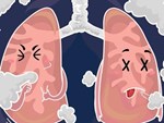 5 loại thực phẩm thanh lọc phổi: Ăn một bữa phổi khoẻ một năm, rất ít người biết cái số 5-2