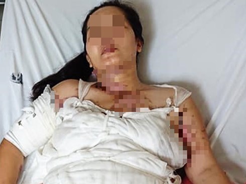 Nấu chè mừng đầy tháng cháu nội, người phụ nữ bị nguyên nồi nước sôi đổ vào người dẫn đến bỏng nặng