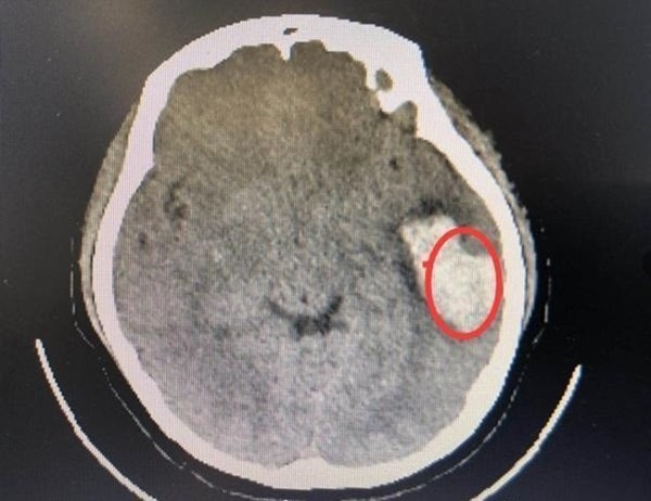 Cô gái bị xuất huyết não vì hát karaoke quá to và lời cảnh báo của bác sĩ-2