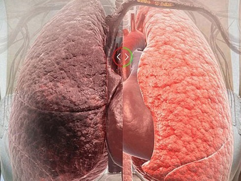 5 loại thực phẩm thanh lọc phổi: Ăn một bữa phổi khoẻ một năm, rất ít người biết cái số 5-1
