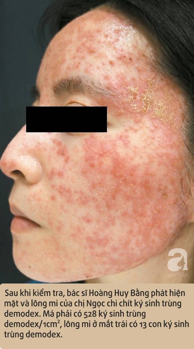 Cô gái bị viêm da suốt 6 năm, cứ 1cm² trên mặt có 528 con ký sinh trùng trên da-1