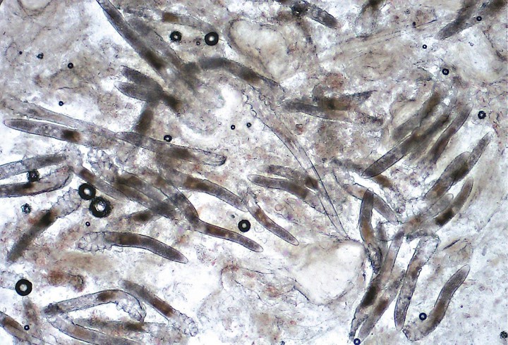 Cô gái bị viêm da suốt 6 năm, cứ 1cm² trên mặt có 528 con ký sinh trùng trên da-3