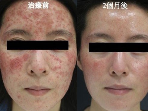 Cô gái bị viêm da suốt 6 năm, cứ 1cm² trên mặt có 528 con ký sinh trùng trên da