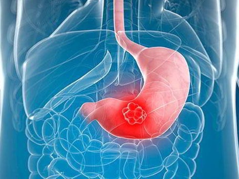 Ung thư dạ dày tấn công cơ thể: Đây là 5 dấu hiệu rõ như ban ngày, hãy nhanh chóng đi gặp bác sĩ-2