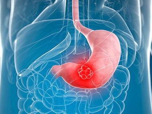 Người đàn ông 31 tuổi bị ung thư dạ dày do ăn thứ này thay cơm trong thời gian dài