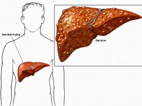 2 việc nếu làm vào buổi sáng có thể gây hại cho gan không kém gì uống nhiều rượu bia-5