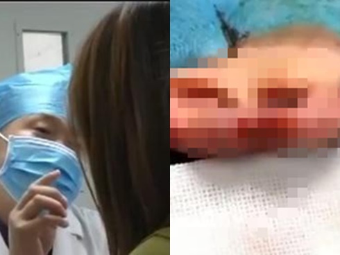 Cô gái trẻ phi xe như bay sai làn đường, húc đầu gây tai nạn-1