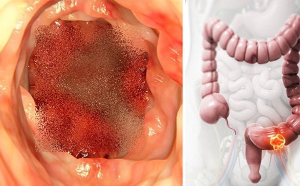 2 loại đau báo hiệu ung thư ruột và 4 kiểu người nên đi khám ngay lập tức để ngăn chặn mầm bệnh-1