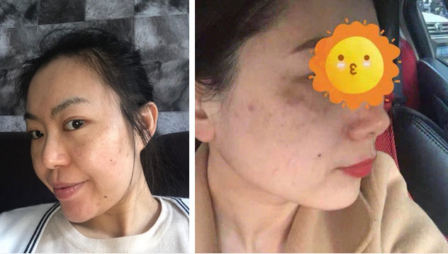 Chỉ cần nhìn vào 2 bên gò má sẽ biết ngay bạn đang bị nám hay đốm nâu-1