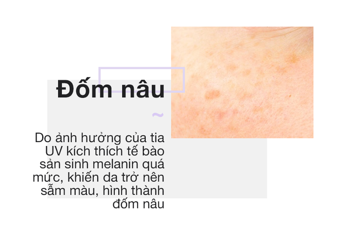 Chỉ cần nhìn vào 2 bên gò má sẽ biết ngay bạn đang bị nám hay đốm nâu-3