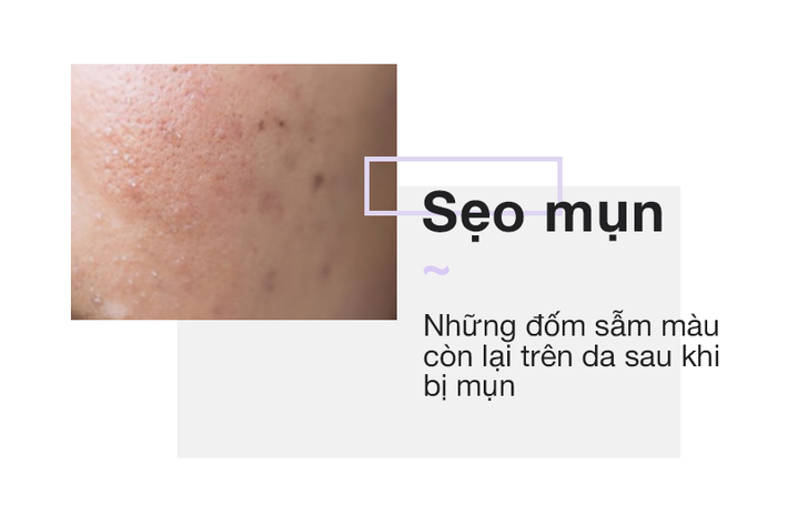 Chỉ cần nhìn vào 2 bên gò má sẽ biết ngay bạn đang bị nám hay đốm nâu-4