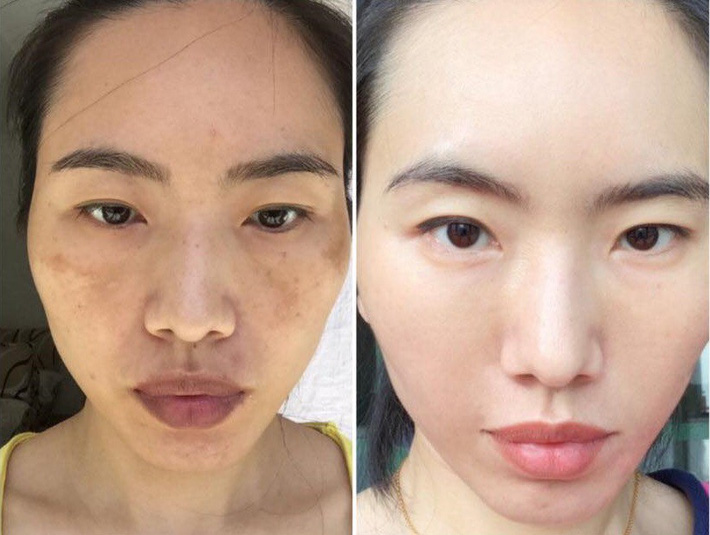 Chỉ cần nhìn vào 2 bên gò má sẽ biết ngay bạn đang bị nám hay đốm nâu-5