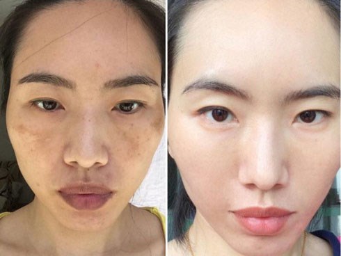 Chỉ cần nhìn vào 2 bên gò má sẽ biết ngay bạn đang bị nám hay đốm nâu