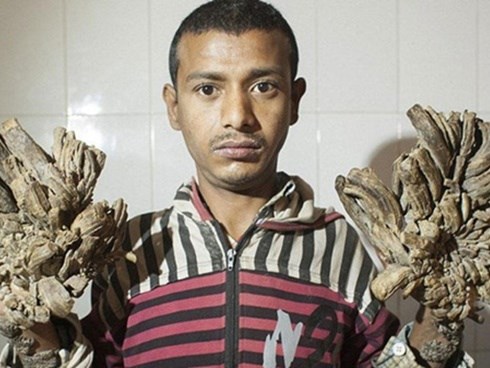 'Người cây' xin được cắt cụt tay sau 25 ca phẫu thuật đau đớn