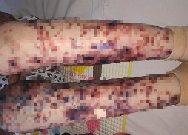 Bé gái Việt mang căn bệnh hiếm, cả thế giới chỉ có 38 trẻ mắc-1