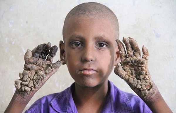 Cuộc sống bế tắc của những người bị mọc rễ cây-1