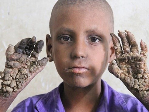 Cuộc sống bế tắc của những người bị 'mọc rễ cây'