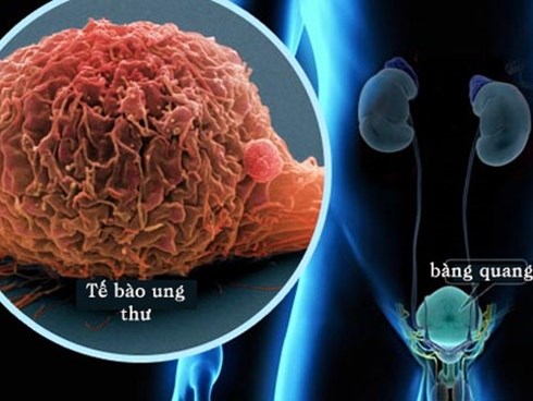 5 dấu hiệu cảnh báo ung thư đang tấn công cơ thể, rất hay bị nhầm lẫn với bệnh thông thường