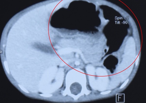 Bé 2 tuổi mang bệnh lý hiếm gặp, thường xuyên nôn ói-2