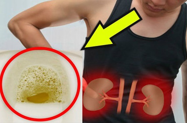 Thấy nước tiểu chuyển sang màu này, hãy cẩn thận vì căn bệnh nguy hiểm đang gõ cửa-1