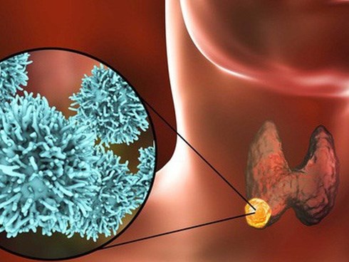 13 tuổi mắc ung thư tuyến giáp: BS cảnh báo bệnh liên quan tới thói quen ăn thiếu chất