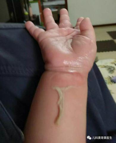 Sai lầm khi sơ cứu bỏng của cha khiến con trai 4 tuổi bị ngộ độc đến mức nhập viện-1