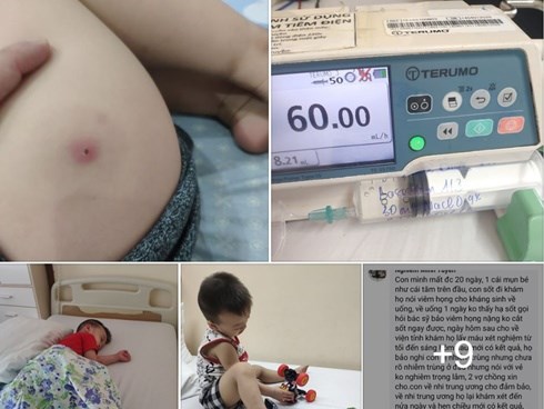 Trẻ 3 tuổi sốt cao, nhiễm trùng máu vì tự ý nặn mụn: Bác sĩ cảnh cáo 4 sai lầm bố mẹ hay làm có thể 'mất con'
