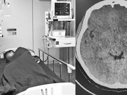 Nữ sinh vỡ mạch máu não khi hát karaoke