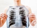 4 dấu hiệu cảnh báo căn bệnh ung thư phổi đang tấn công cơ thể, đừng coi thường kẻo mất mạng-2