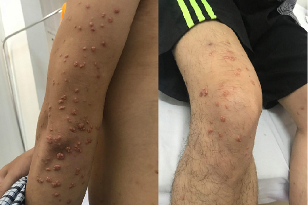 Nam thanh niên tự nặn mụn, hoá ra nốt sùi mọc tua tủa khắp người-1